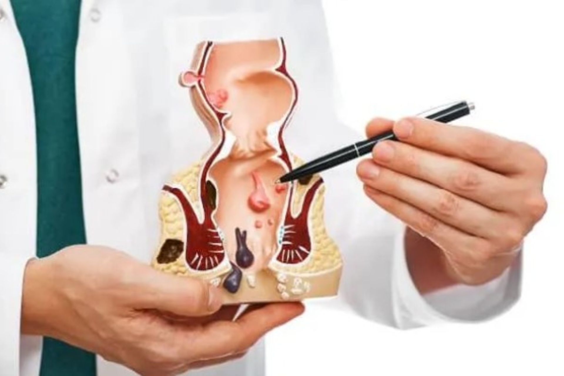 এনাল ফিসার কি? এনাল ফিসার থেকে মুক্তির উপায়।